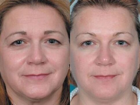 fotod enne ja pärast naha naha noorendamist