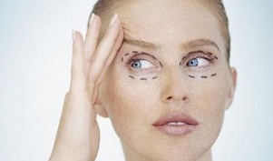 blefaroplastika tüübid silmaümbruse naha noorendamiseks
